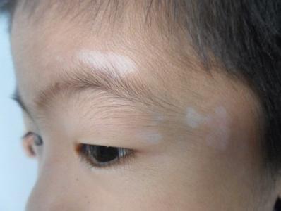 武汉专业治疗白癜风医院？武汉儿童白癜风饮食该怎么注意？