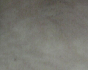 ҽԺ人ڶͰЩ֢״أ